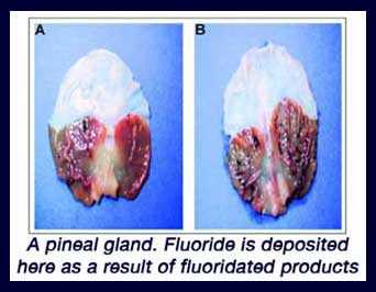 calcified_pineal_gland